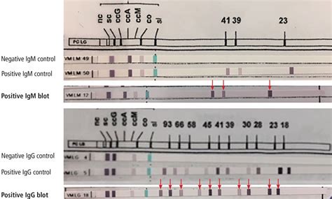 elisa test labcorp|lyme disease line blot LabCorp.